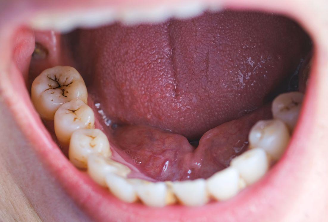 How Bad Oral Hygiene Can Lead To Oral Cancer