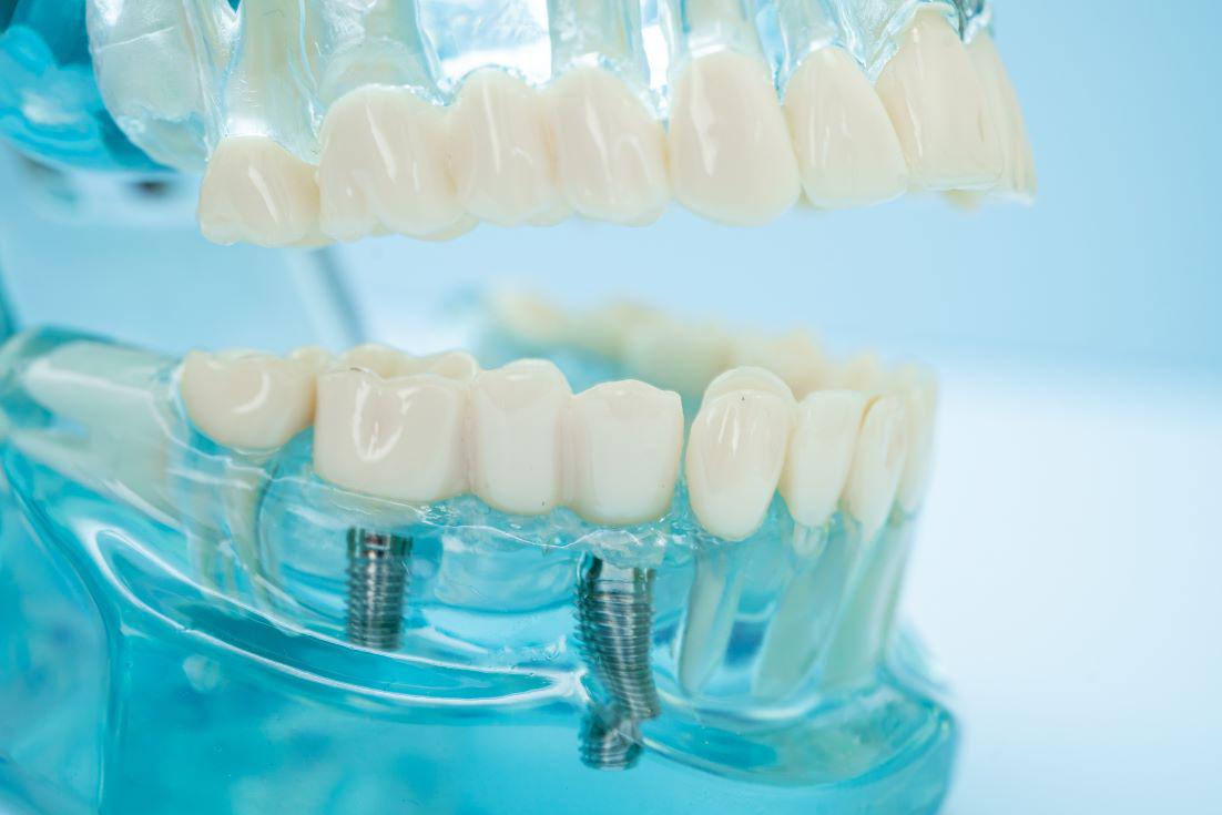 How Do I Clean My Dental Implants?